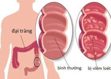 Đau bụng dưới bên trái bị bệnh gì 5 Đau bụng dưới bên trái bị bệnh gì